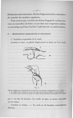 Fig. 6. Schéma expliquant le mécanisme de la chute dans les luxations intermittentes de la rotule. - [...]