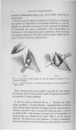 Fig. 7. Le sac de la hernie currale est isolé. La section du ligament de Gimbernat est indiquée / Fi [...]