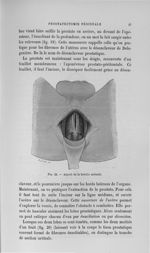 Fig. 22. Aspect de la brèche urétrale - Titres et travaux