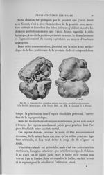 Fig. 22. Reproduction grandeur nature des lobes prostatiques présentés à la société anatomique, le 2 [...]