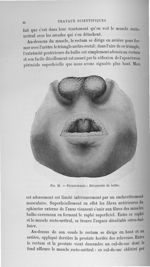Fig. 28. Périnéotomie : Découverte du bulbe - Titres et travaux
