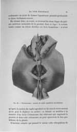 Fig. 29. Périnéotomie : section du raphé superficiel ano-bulbaire - Titres et travaux