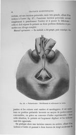 Fig. 30. Périnéotomie : Décollement et relèvement du bulbe - Titres et travaux