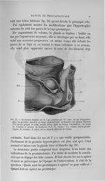 Fig. 35. Ouverture latérale de la loge prostatique F.l dans un cas d'hypertrophie. La prostate décol [...]