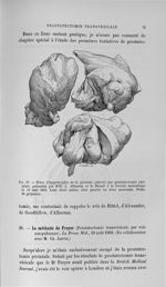 Fig. 37. Pièce d'hypertrophie de la prostate enlevée par prostatectomie périnéale, présentée par MM. [...]