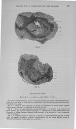 Fig. 1, 2, 3. - a, artère ; c, canal biliaire ; v. veine - Titres et travaux scientifiques
