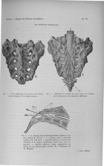 Fig. 1. Face postérieure du sacrum avec l'hiatus sacro-coccygien et les repères osseux / Fig. 2. Mon [...]