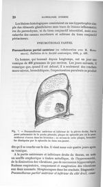 Fig. 7. Pneumothorax antérieur et inférieur de la plèvre droite - Concours d'agrégation 1904. Exposé [...]