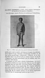 Fig. 28. Même sujet après deux mois de traitement thyroïdien - Concours d'agrégation 1904. Exposé de [...]