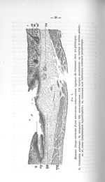 Fig. 1. Coupe verticale d'une ulcération tuberculeuse typique de l'estomac chez un phtisique - Conco [...]