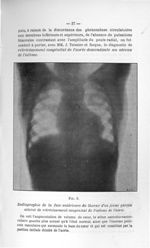 Fig. 5. Radiographie de la face antérieure du thorax d'un jeune garçon atteint de rétrécissement con [...]