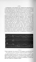 Fig. 6. Tracés montrant les caractères et les rapports simultanés du choc de la pointe du coeur, du  [...]