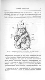 Fig. 1. Nodules sarcomateux sur les gaines des nerfs crâniens - Titres et travaux scientifiques