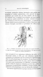 Fig. 2. Nodules sarcomateux sur les racines de la queue de cheval - Titres et travaux scientifiques