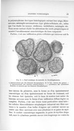 Fig. 3. Nerf sciatique de maladie de Recklinghausen - Titres et travaux scientifiques