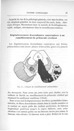 Fig. 5. Foyers de ramollissement pédonculaire - Titres et travaux scientifiques