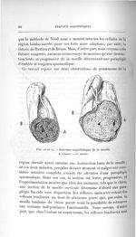 Fig. 10 et 11. Sarcome angiolithique de la moelle - Titres et travaux scientifiques