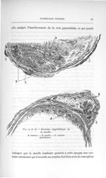 Fig. 12 et 13. Sarcome angiolithique de la moelle - Titres et travaux scientifiques