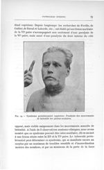 Fig. 19. Syndrome protubérantiel supérieur. Paralysie des mouvements de latéralité des globes oculai [...]