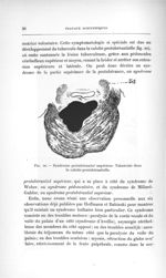 Fig. 20. Syndrome protubérantiel supérieur. Tubercule dans la calotte protubérantielle - Titres et t [...]