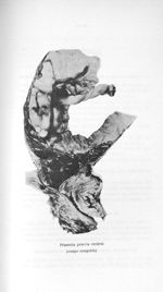 Placenta proevia central (coupe congelée) - Concours pour l'agrégation, 1904, section de chirurgie e [...]