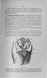 Fig. 6. Obstruction par coudure de l'iléon, due à la traction du diverticule fixé dans une hernie -  [...]