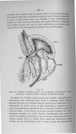 Fig. 17. Coupe de l'appareil uréthro-vésical d'un prostatique cystostomisé depuis deux ans - Titres  [...]