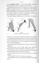 Fig. 3. Les divers accolements du méso-côlon - Titres et travaux scientifiques