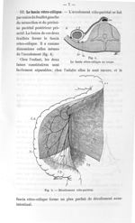 Fig. 4. Le fascia rétro-côlique en coupe / Fig. 5. Décollement côlo-pariétal - Titres et travaux sci [...]