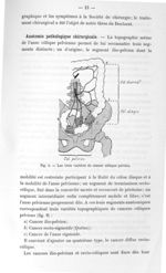 Fig. 9. Les trois variétés de cancer côlique pelvien - Titres et travaux scientifiques