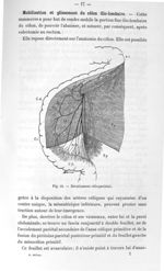 Fig. 10. Décollement côlo-pariétal - Titres et travaux scientifiques