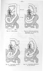 Fig. 11. Côlon normal / Fig. 12. Colectomie pelvienne ; abaissement et élévation des deux bouts côli [...]