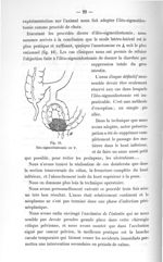 Fig. 16. Iléo-sigmoïdostomie en Y - Titres et travaux scientifiques