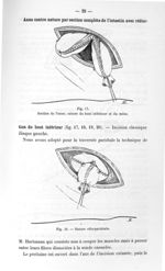 Fig. 17. Section de l'anse ; suture du bout inférieur et du méso / Fig. 18. Suture côlo-pariétale -  [...]