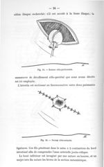 Fig. 19. Suture côlo-péritonéale / Fig. 20. Suture côlo-cutanée - Titres et travaux scientifiques