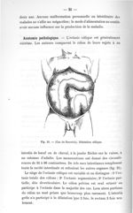 Fig. 21. (Cas de Fenwick). Dilatation côlique - Titres et travaux scientifiques