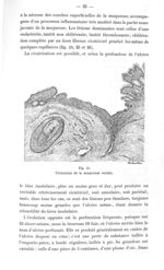 Fig. 24. Ulcération de la muqueuse rectale - Titres et travaux scientifiques