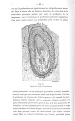Fig. 25. Coupe de l'artère thrombosée - Titres et travaux scientifiques