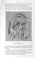 Fig. 28. Ligature trans-méso-côlique - Titres et travaux scientifiques