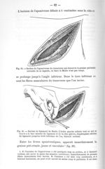 Fig. 39. Section de l'aponévrose du transverse qui découvre la graisse périnéale entourée de sa caps [...]