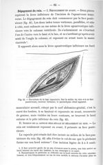 Fig. 42. Ouverture de la loge capsulaire - Titres et travaux scientifiques