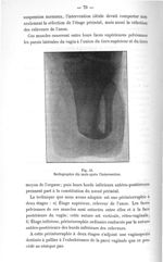 Fig. 48. Radiographie dix mois après l'intervention - Titres et travaux scientifiques