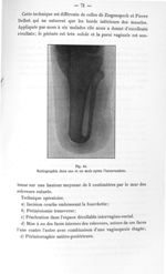 Fig. 49. Radiographie deux ans et un mois après l'intervention - Titres et travaux scientifiques