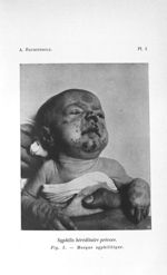 Fig. 1. Masque syphilitique - Concours d'agrégation, chirurgie et accouchements, 11 mars 1904. Expos [...]