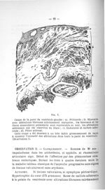 Fig. 1. Coupe de la paroi du ventricule gauche - Concours pour l'agrégation, 1904, section de pathol [...]