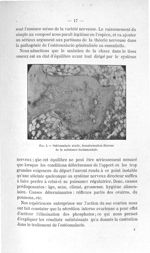 Fig. 4. Ostéomalacie sénile, transformation fibreuse de la substance fondamentale - Concours d'agrég [...]