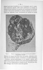 Figure 1. Tumeur sarcomateuse de l'arrière-cavité du grand épiploon 1/2 grandeur naturelle - Exposé  [...]