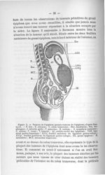 Figure 3. Tumeur de l'épiploon (pseudo-tumeur de l'épiploon), d'après Bormann - Exposé des titres et [...]