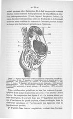 Figure 4. Tumeur de l'arrière-cavité des épiploons (observation personnelle) - Exposé des titres et  [...]