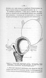 Figure 5. Utérus double. Hématométrie latérale. Hématosalpinx. (Figure schématique) - Exposé des tit [...]